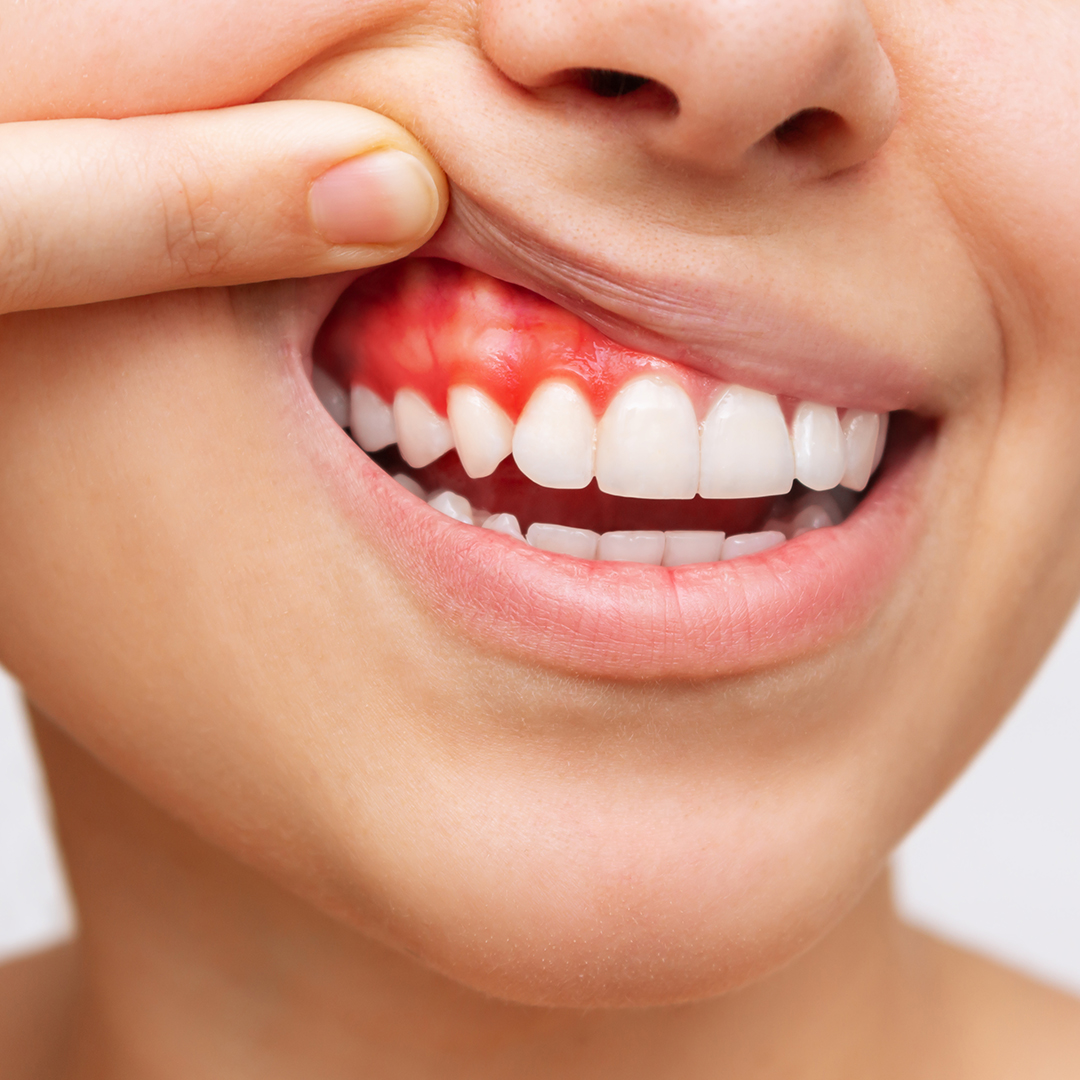 diabetes y problemas dentales gingivitis