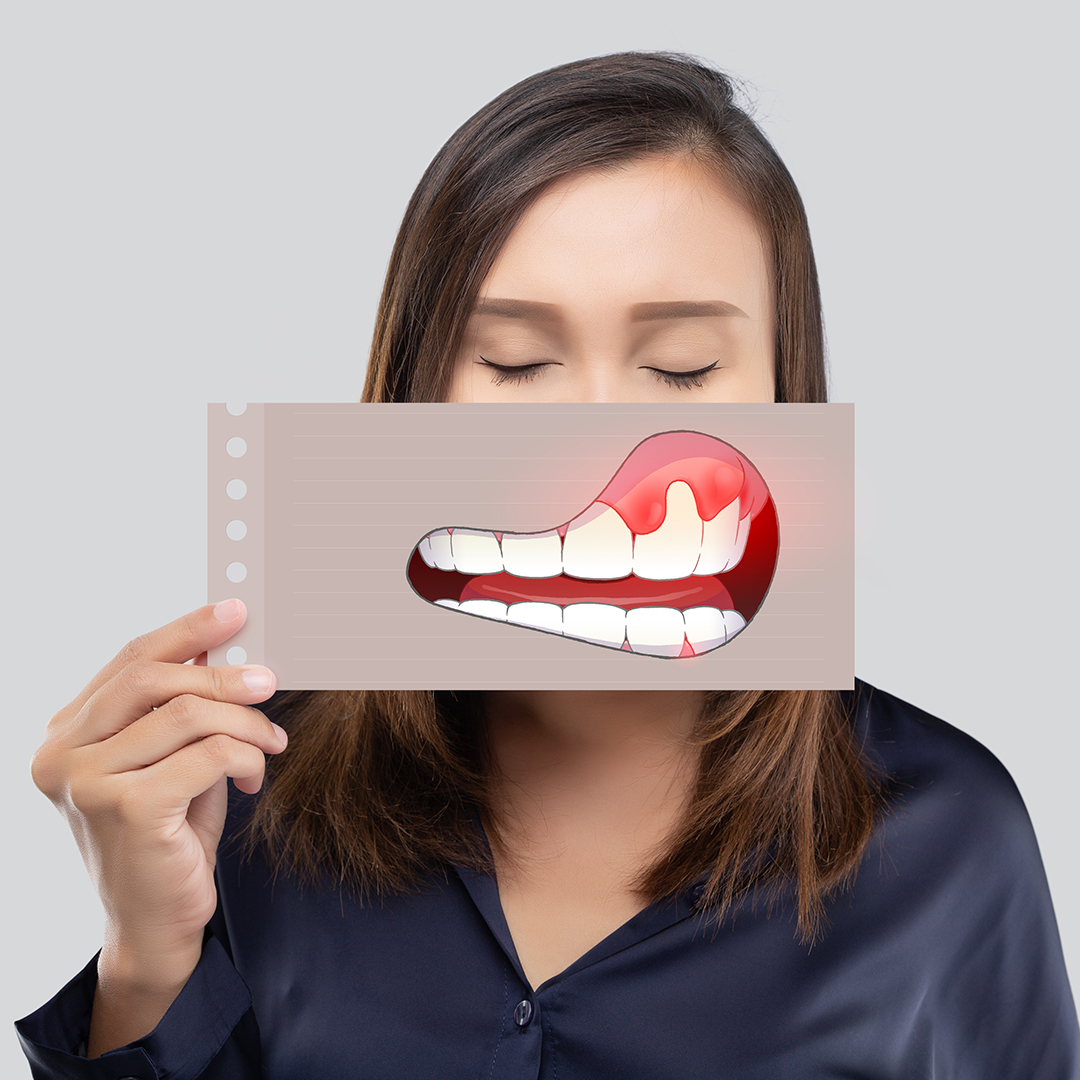 gingivitis