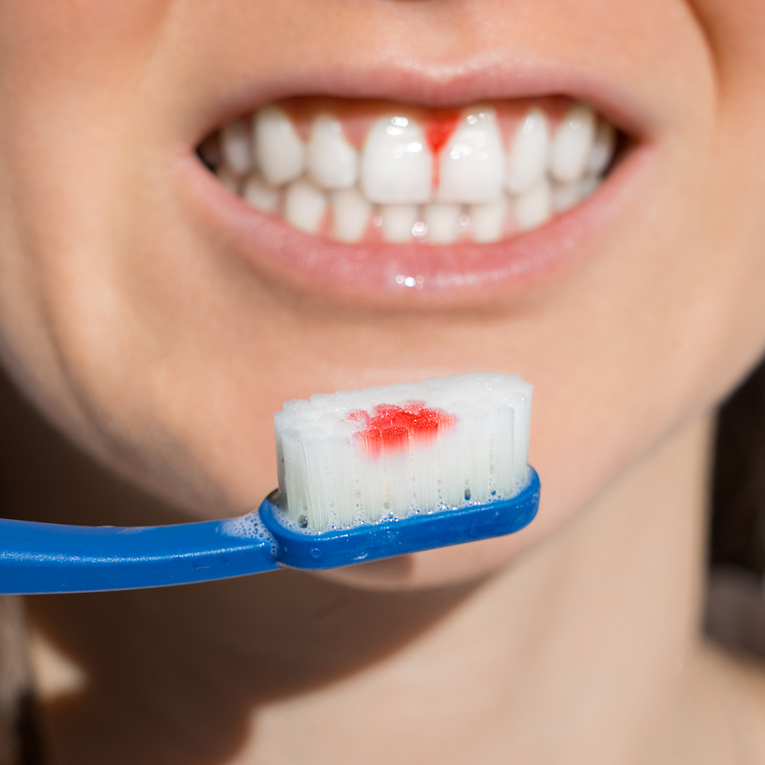 gingivitis
