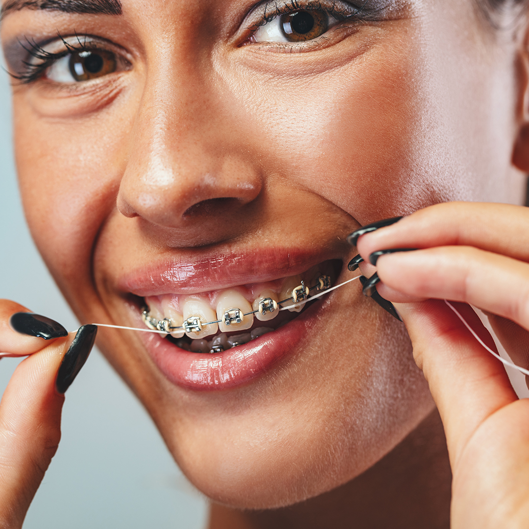 tipos de hilo dental superfloss