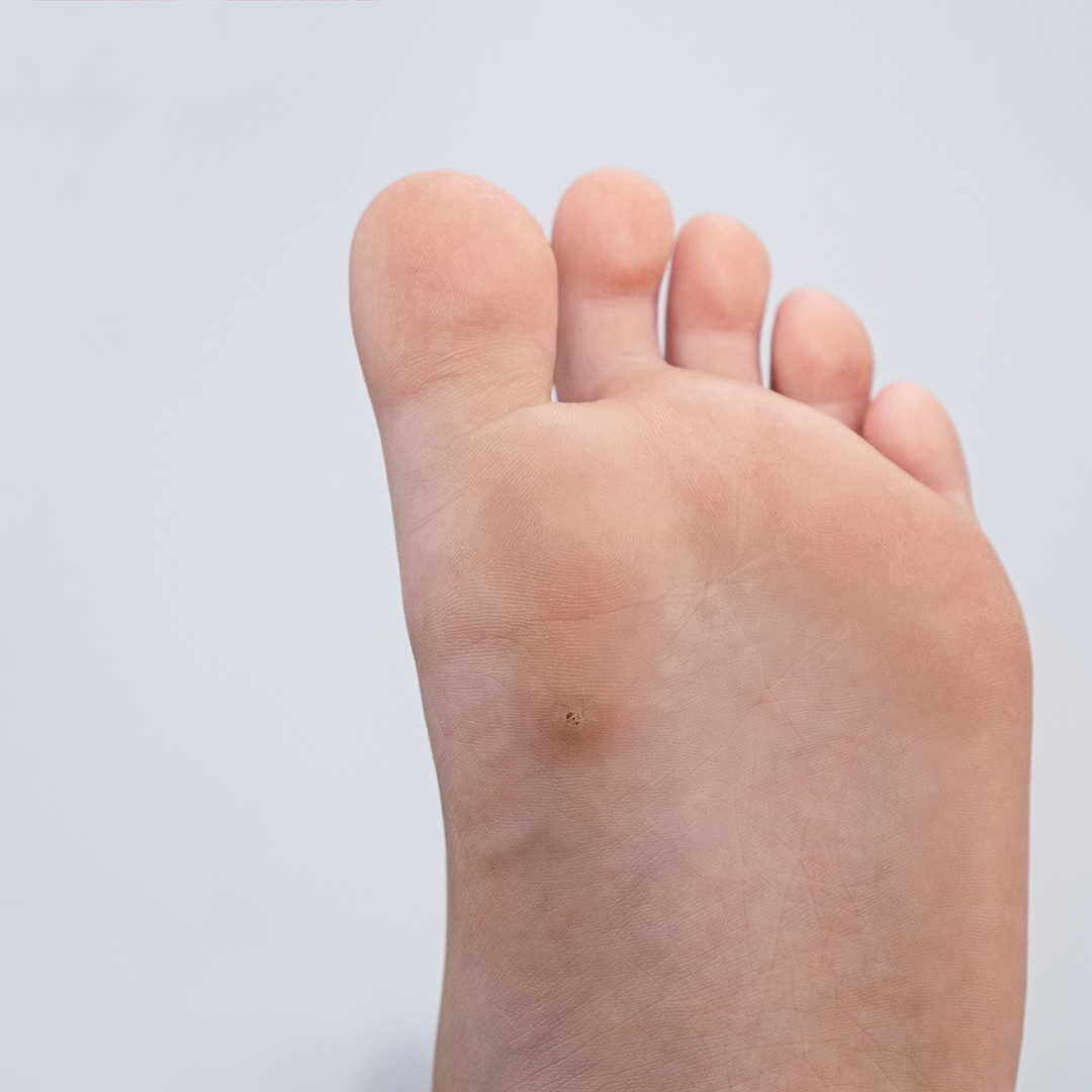 verruga plantar unica