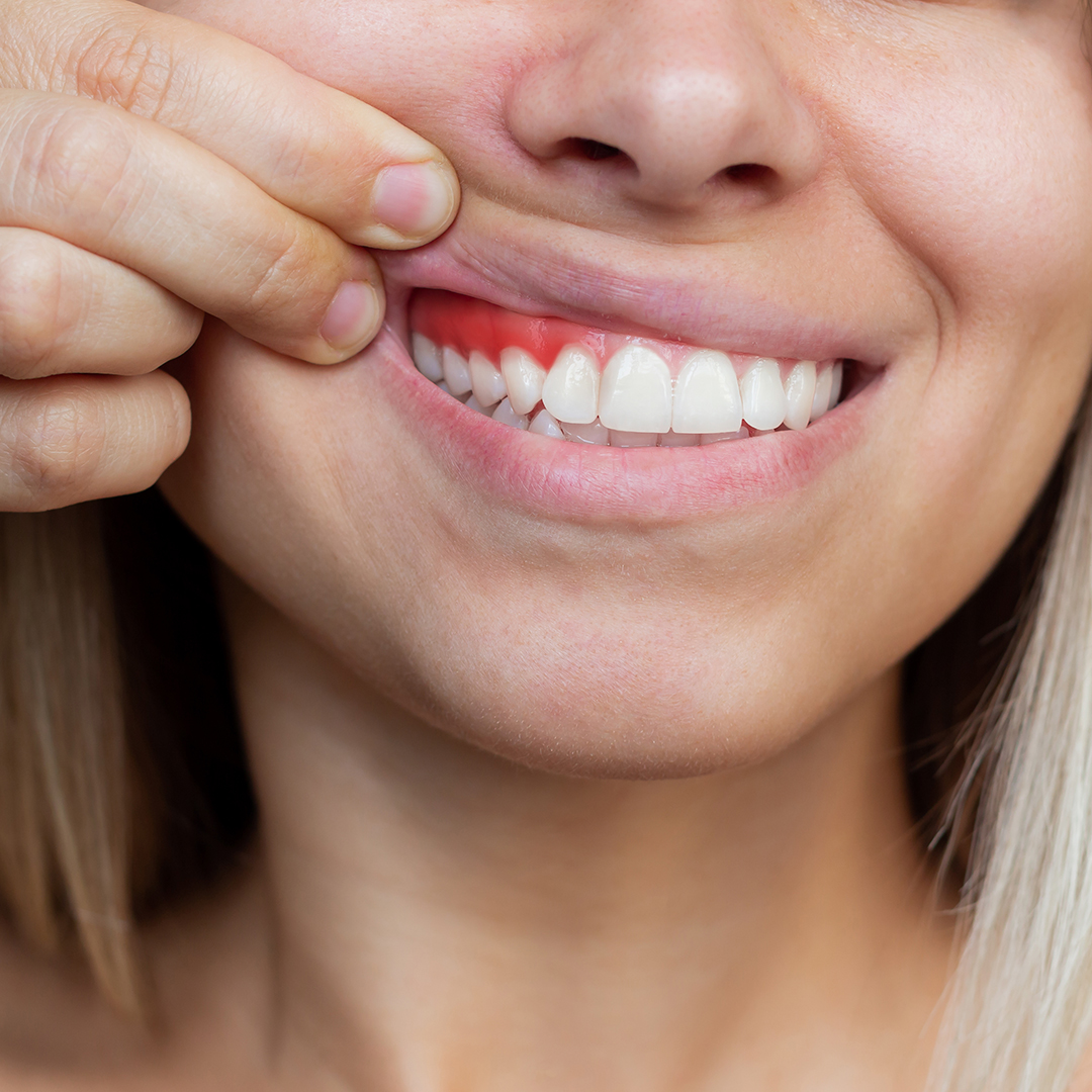gingivitis