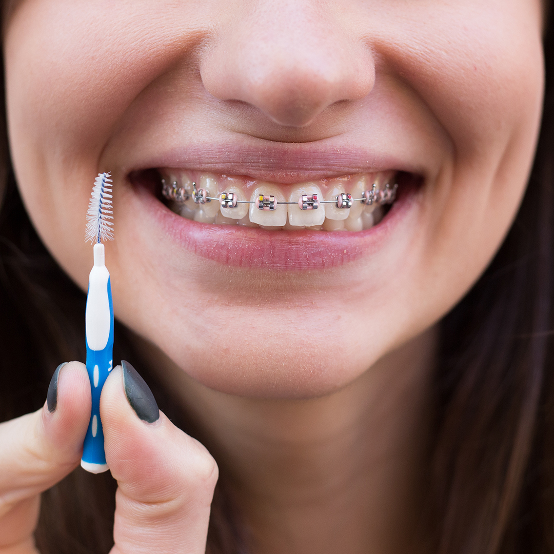 recomendaciones después de ponerse brackets higiene bucal