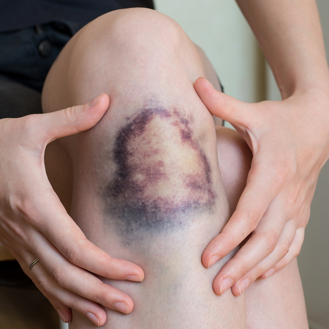 contusión en rodilla tratamiento paso a paso