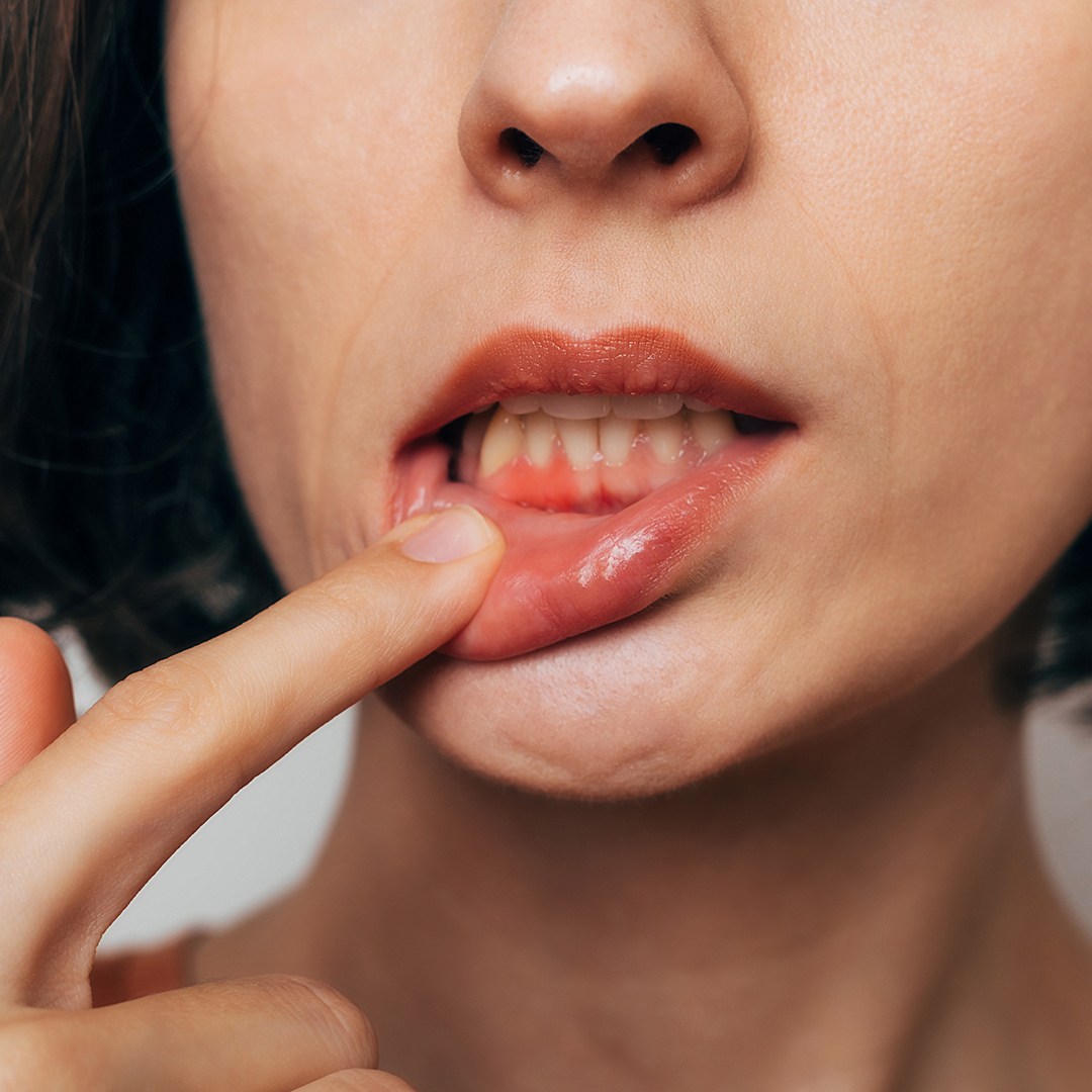 anemia en la boca