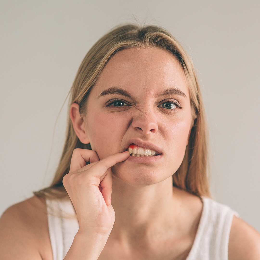 anemia y encías gingivitis periodontitis
