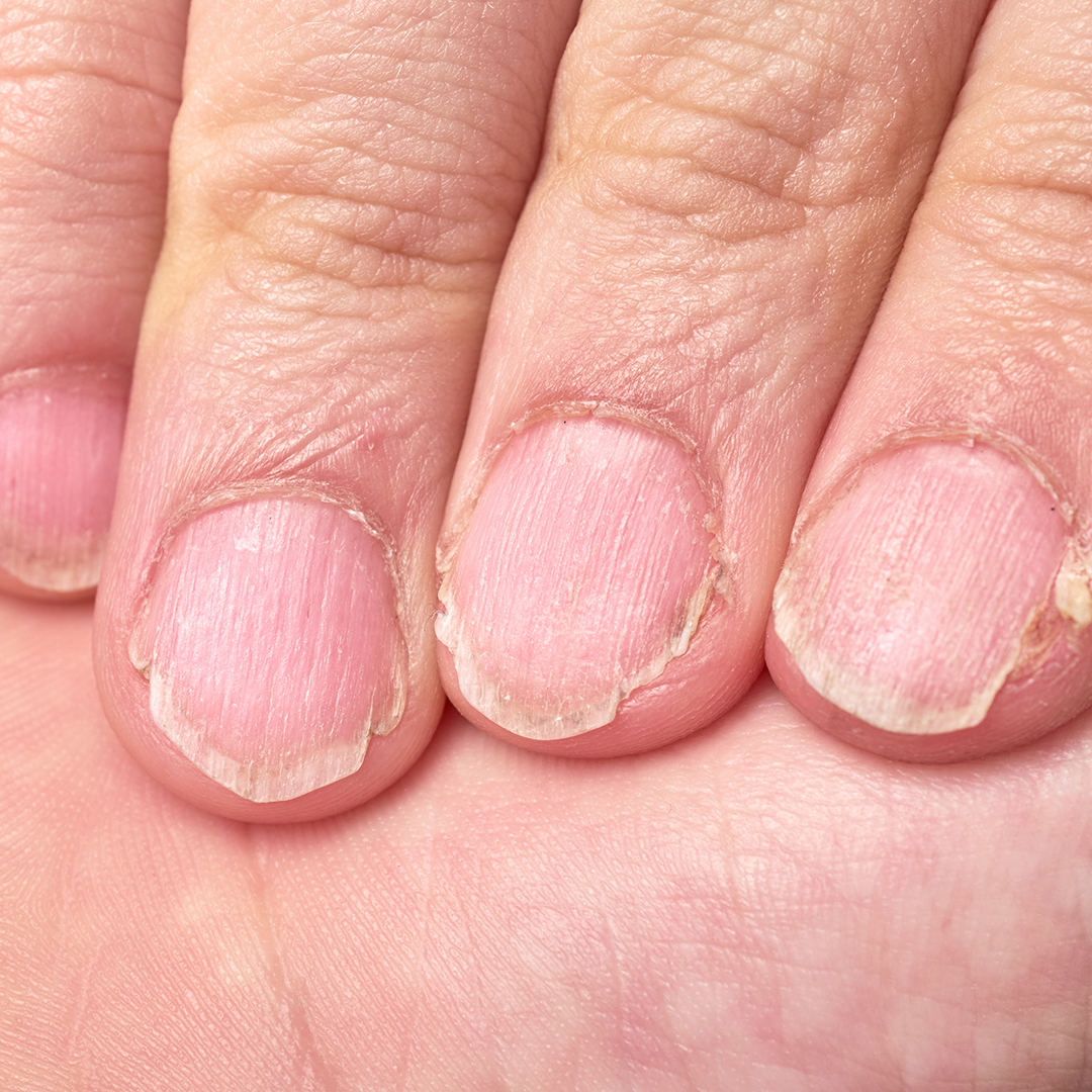 uñas quebradizas