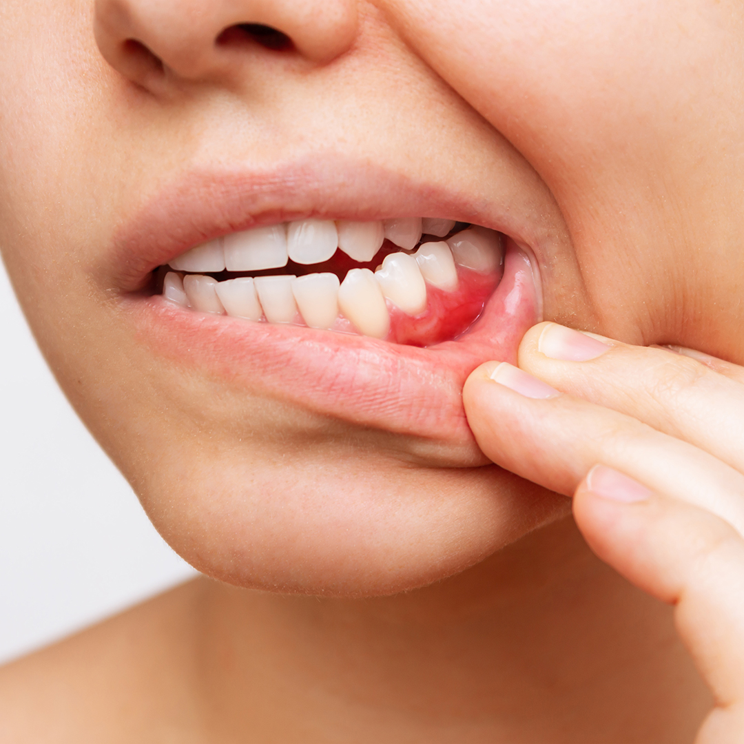 qué es la gingivitis y síntomas