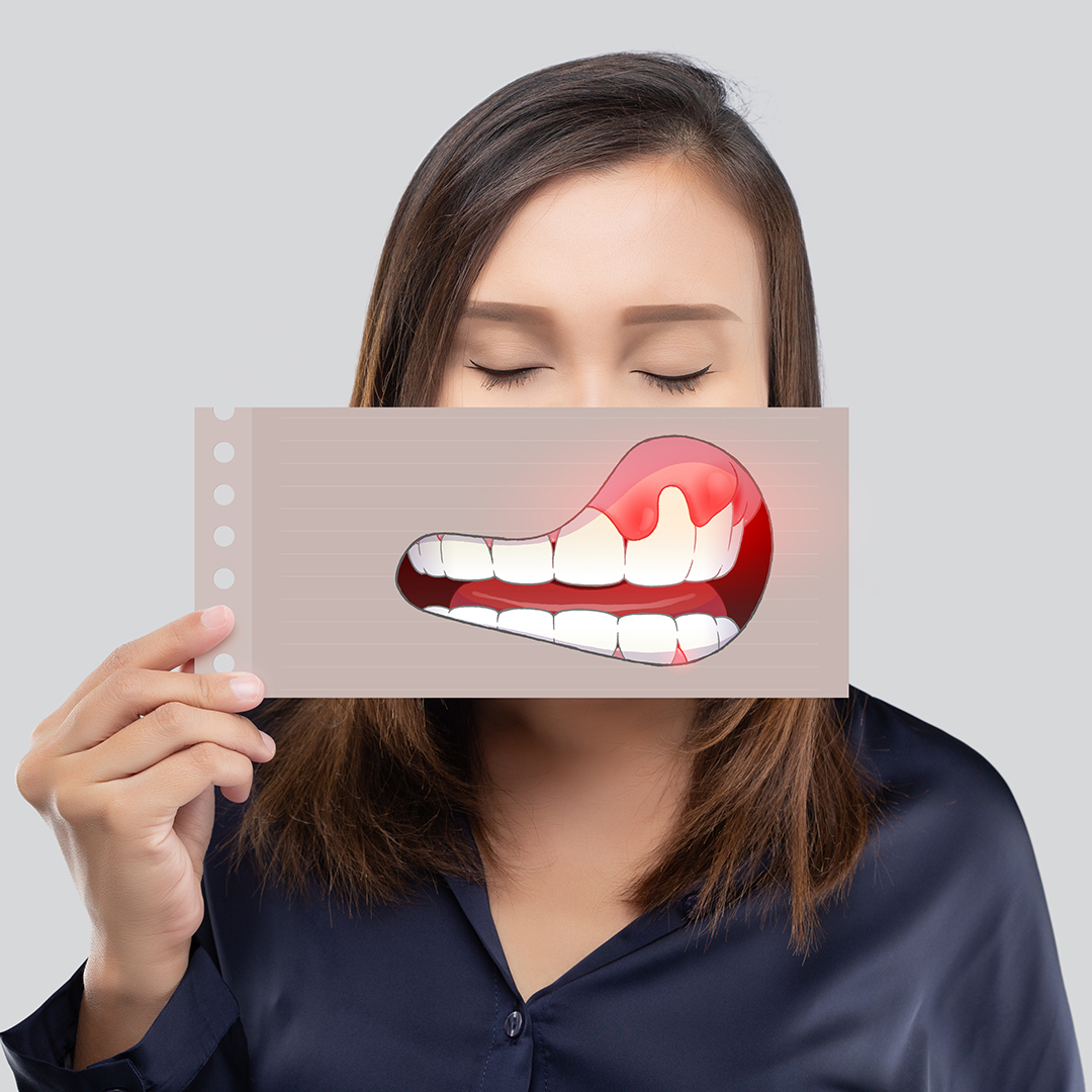 gingivitis y periodontitis