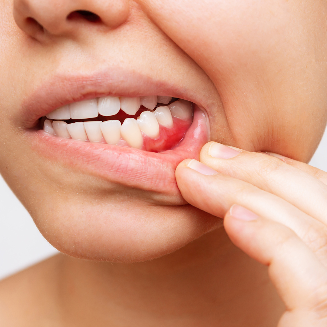 gingivitis