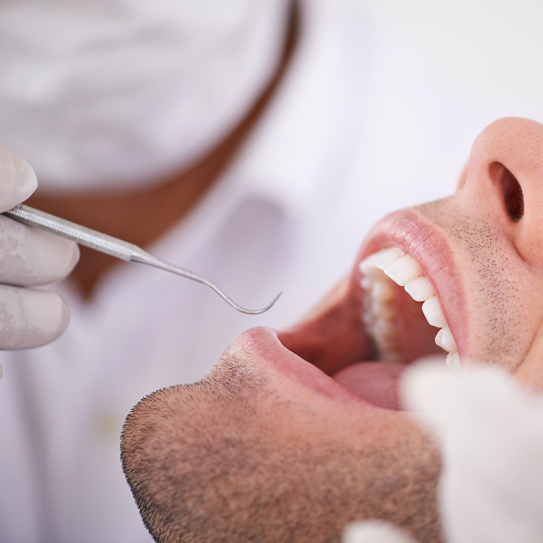 periodontitis curetaje