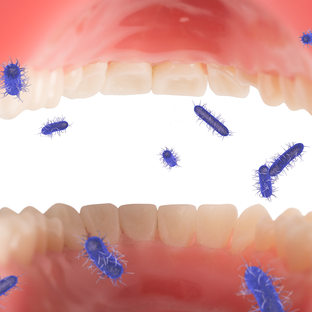 acumulación placa dental