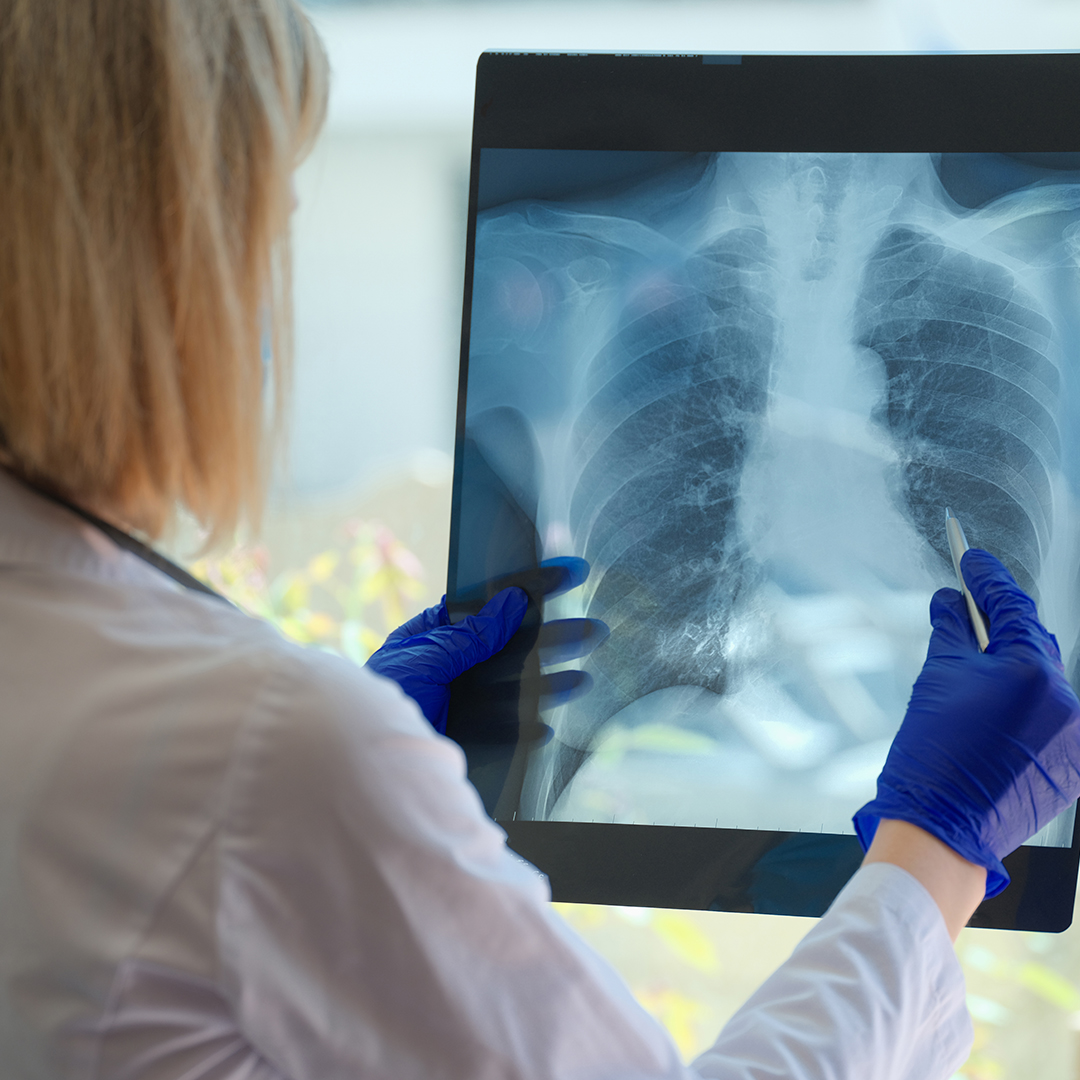 mejorar función pulmonar