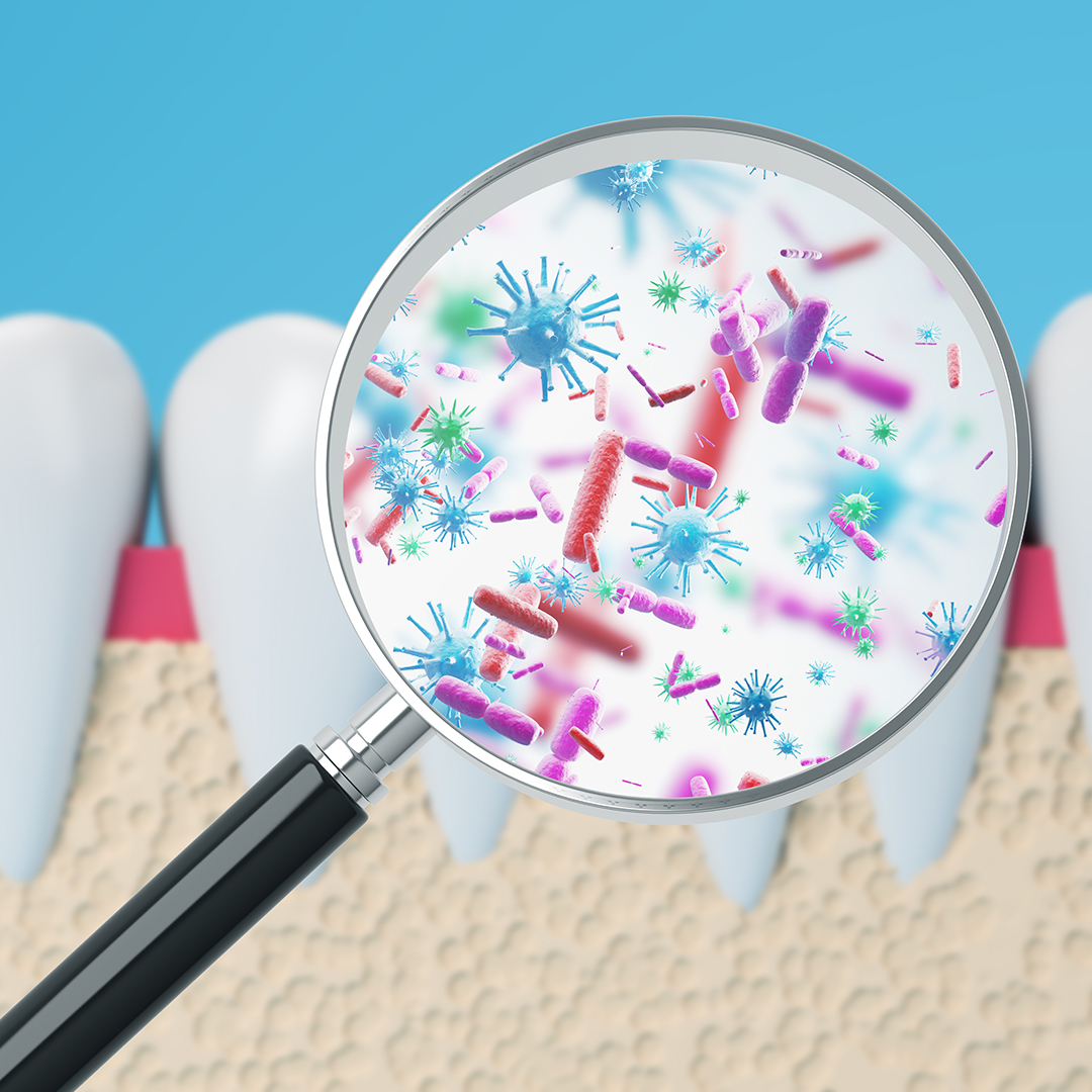 gingivitis acumulación de placa