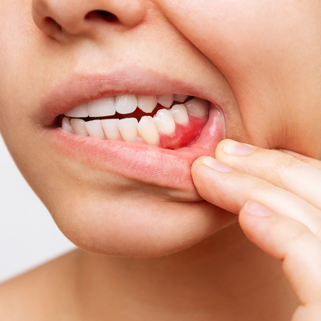 gingivitis qué es