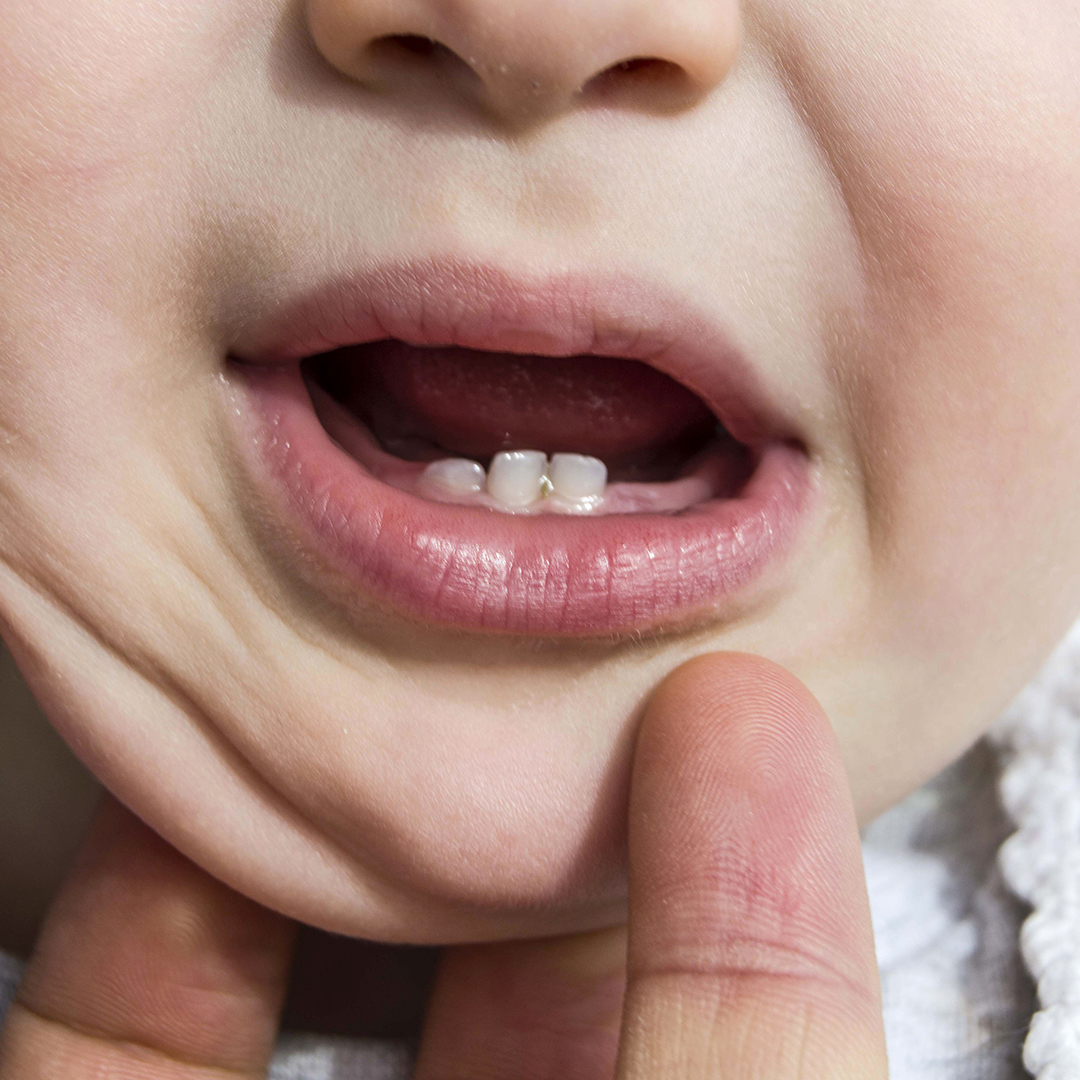 dolor en la dentición